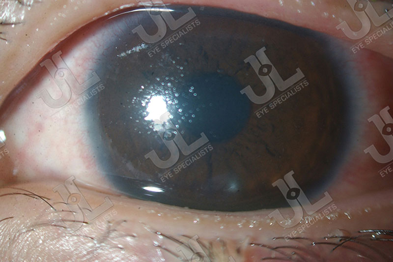 Dr Jimmy Lim JL Eye Specialists Clinic in Singapore Eye Allergy Black Spots Cornea
