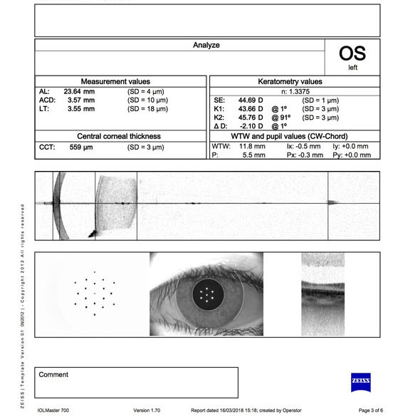 Child Left Eye with Myopia