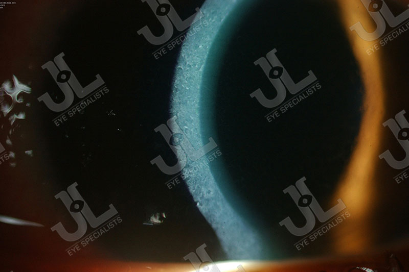 Dr Jimmy Lim JL Eye Specialists Clinic in Singapore Eye Allergy Uveitis