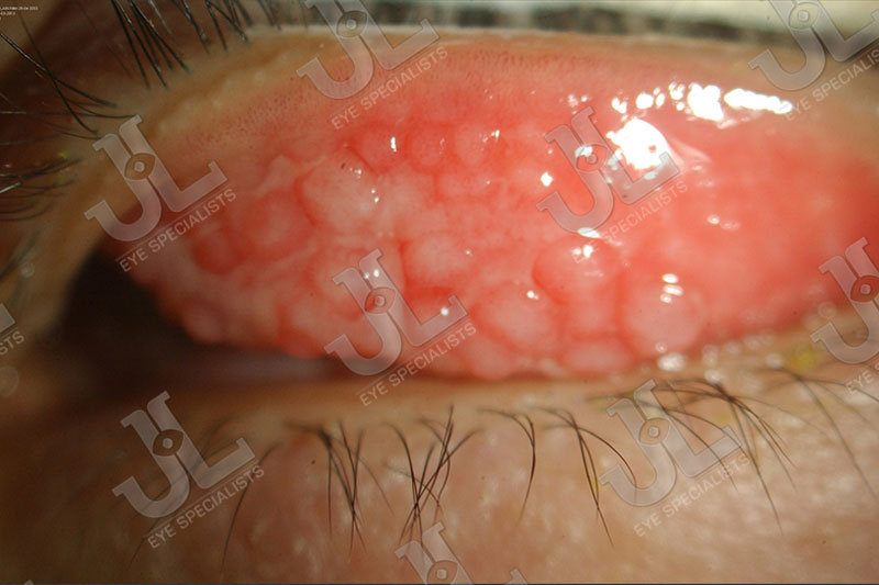 Dr Jimmy Lim JL Eye Specialists Clinic in Singapore Eye Allergy Sty