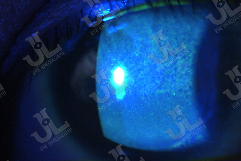Dr Jimmy Lim JL Eye Specialists Clinic in Singapore Eye Care Contact Lens Overwear