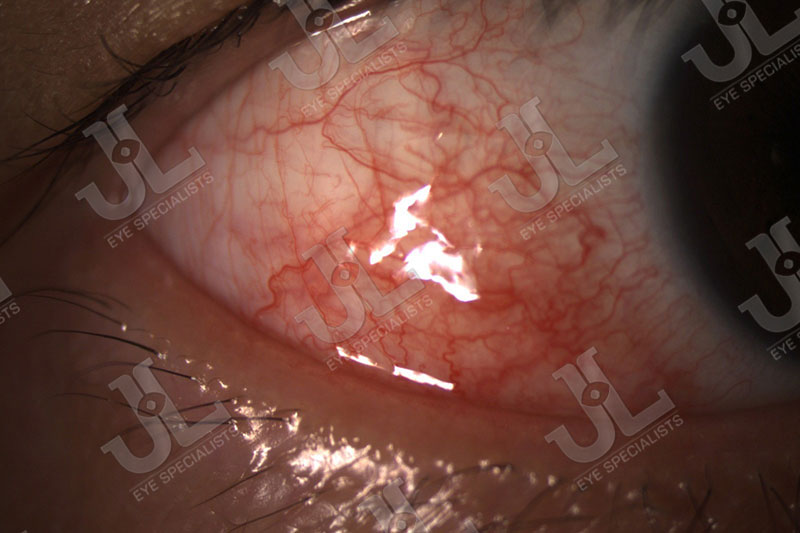 Dr Jimmy Lim JL Eye Specialists Clinic in Singapore Eye Disease Imaging Episcleritis Light