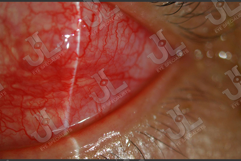 Dr Jimmy Lim JL Eye Specialists Clinic in Singapore Eye Disease Imaging Episcleritis