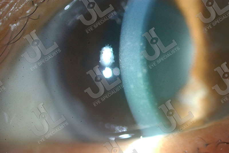 Dr Jimmy Lim JL Eye Specialists Clinic in Singapore Eye Disease Imaging Uveitis Light