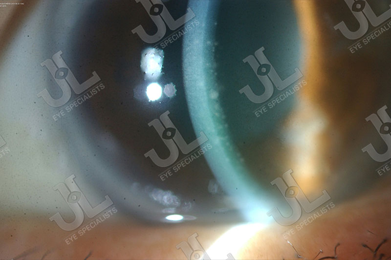 Dr Jimmy Lim JL Eye Specialists Clinic in Singapore Eye Disease Imaging Uveitis