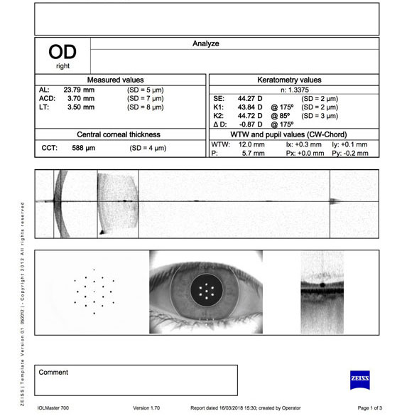 Child Right Eye with Myopia