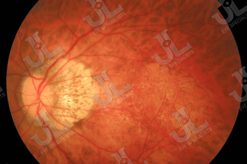 myopia-imaging-left