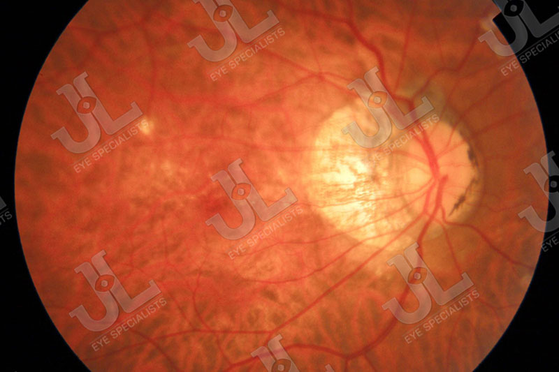 Dr Jimmy Lim JL Eye Specialists Clinic in Singapore Myopia Control Service Imaging Right