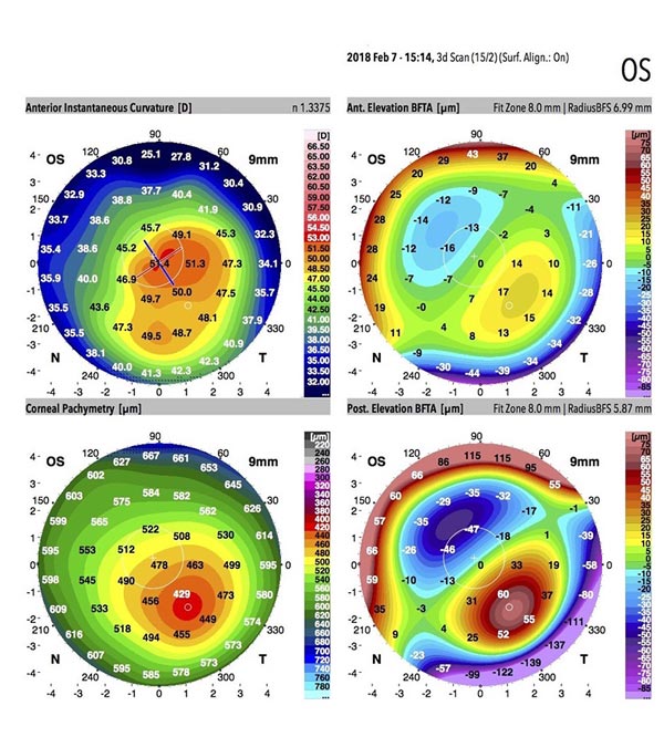 Dr Jimmy Lim JL Eye Specialists Cornea Abnormal Cornea Topographical Galilei G6 Scan Results KPI 93