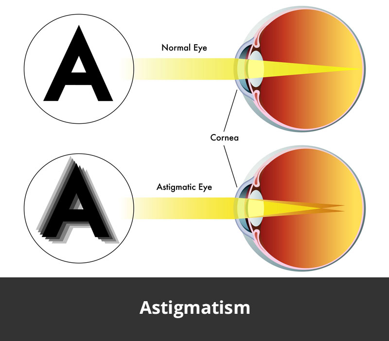 Dr Jimmy Lim JL Eye Specialists Astigmatism Chart