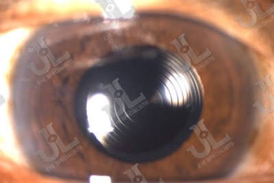 cataract-imaging-flacs-technology-brown