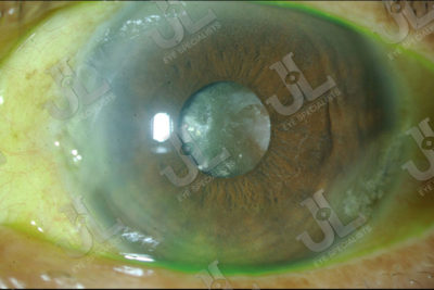 Dr Jimmy Lim JL Eye Specialists Phacoemulsification Catarct Eye Imaging
