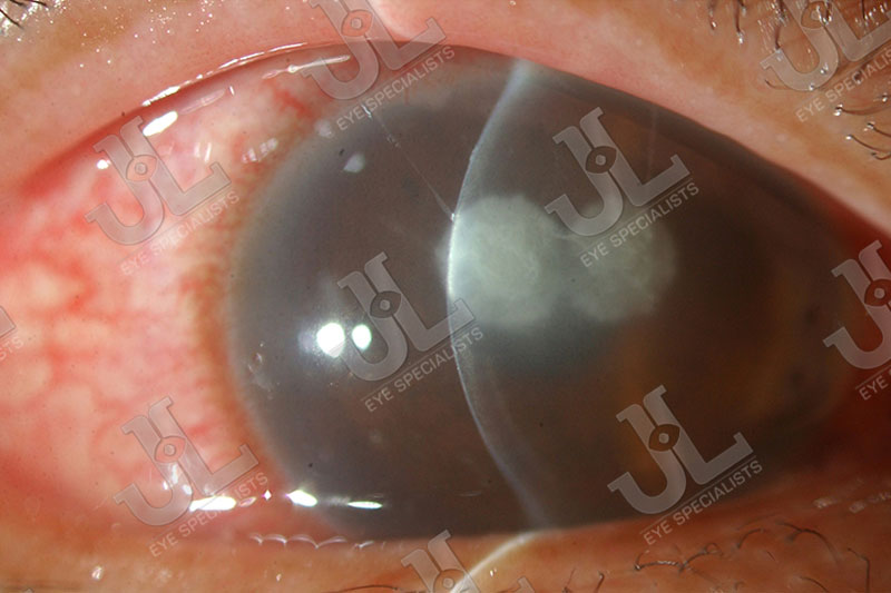 Dr Jimmy Lim JL Eye Specialists Cornea Bacterial Infection Clear