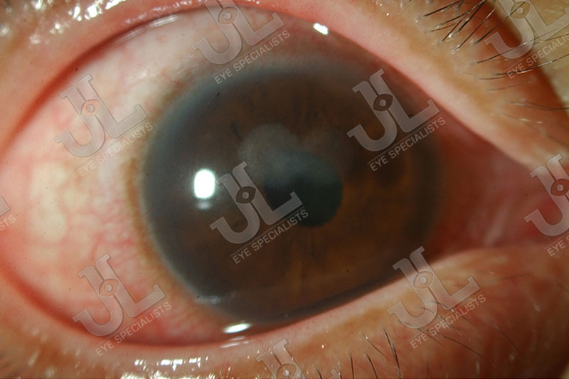 Dr Jimmy Lim JL Eye Specialists Cornea Bacterial Infection Light