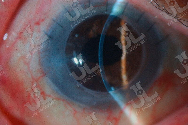 Dr Jimmy Lim JL Eye Specialists Cornea Imaging Donor Eye