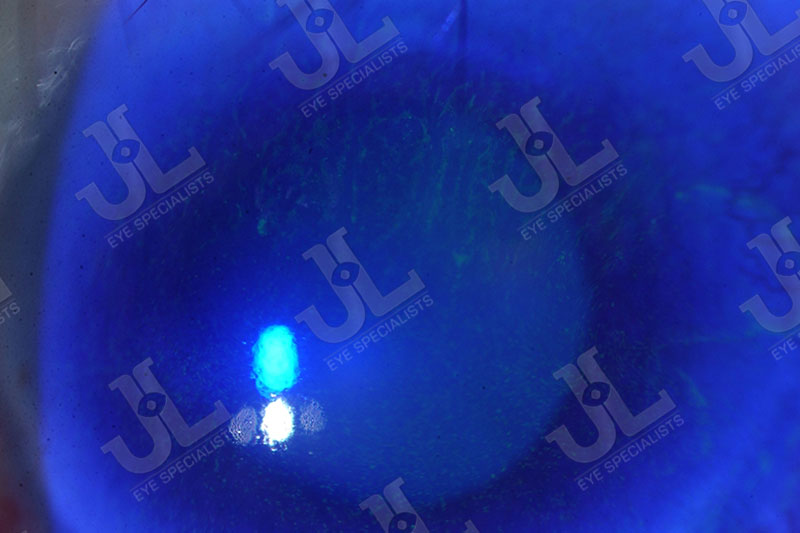 Dr Jimmy Lim JL Eye Specialists Cornea Poor Ocular Surfaces Blue
