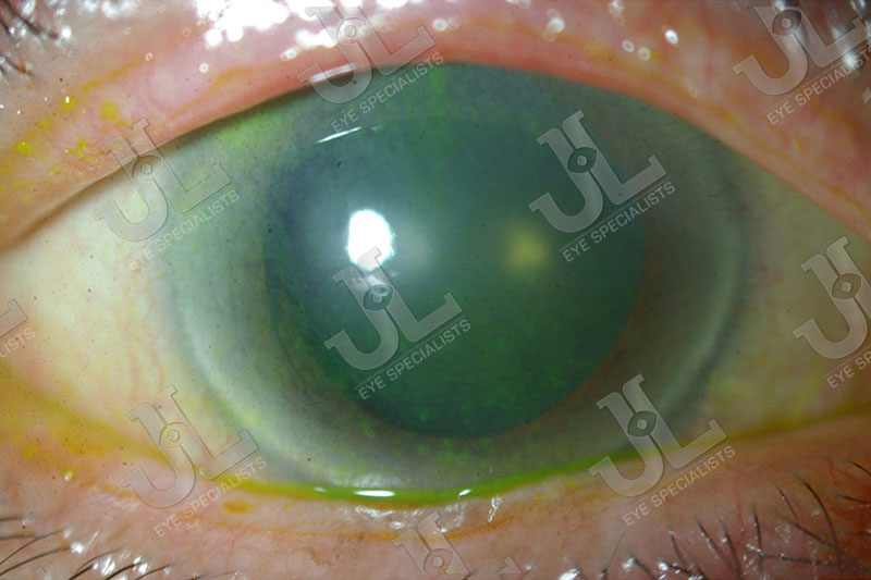 Dr Jimmy Lim JL Eye Specialists Cornea Poor Ocular Surfaces Green