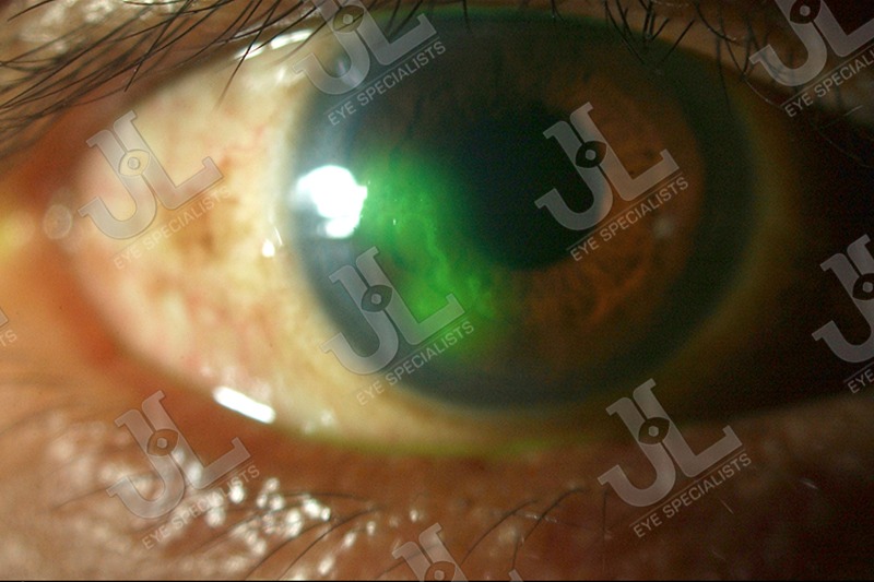 Dr Jimmy Lim JL Eye Specialists Cornea Virus Infection Full Eye