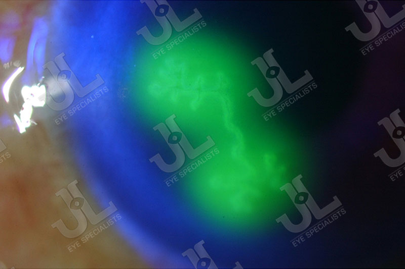 Dr Jimmy Lim JL Eye Specialists Cornea Virus Infection Zoom