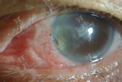 Dr Jimmy Lim JL Eye Specialists Pterygium Cornea Center Eye