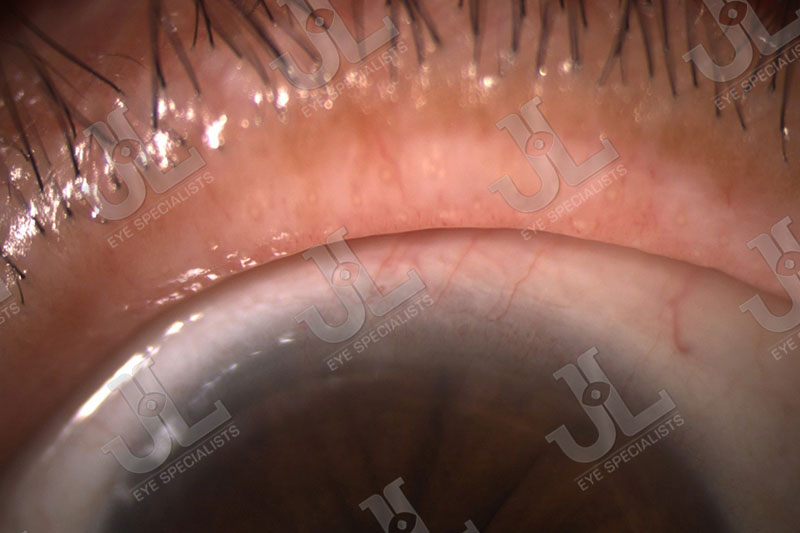 Dr Jimmy Lim JL Eye Specialists Clinic in Singapore Dry Eye Lid Margin Disease Upper Eyelid