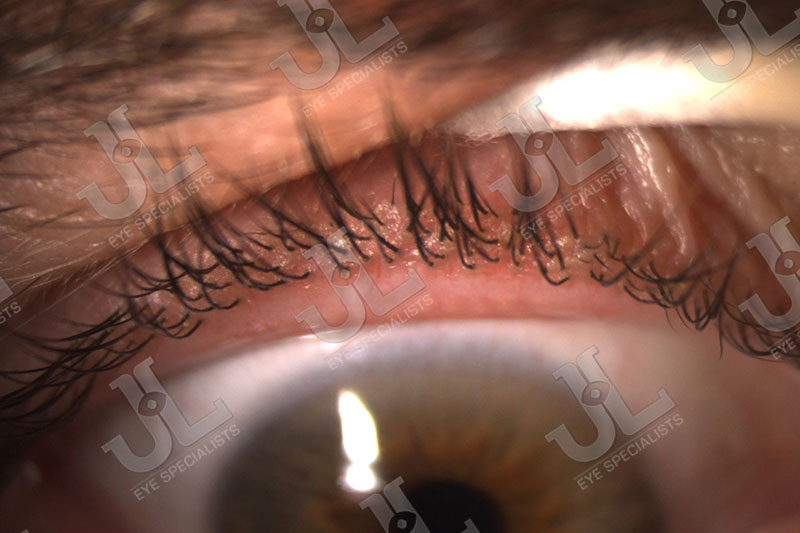 dry-eyes-meibomian-gland-dysfunction-upper-eyelid