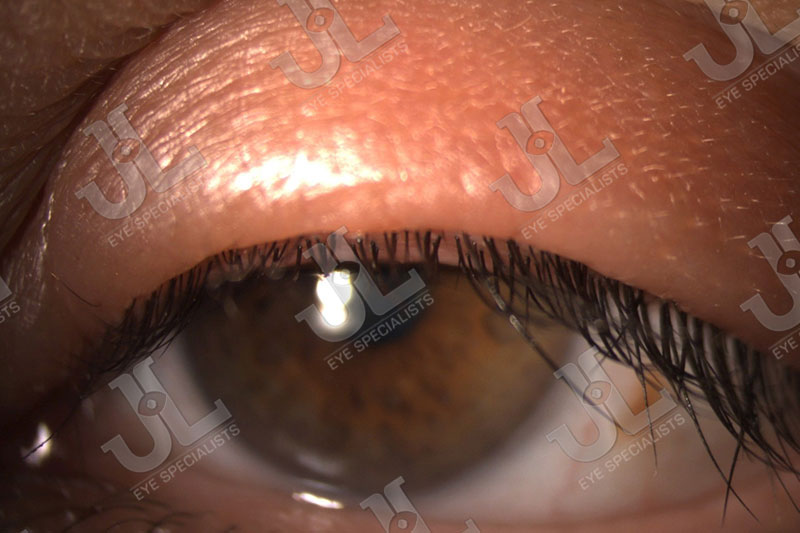Dr Jimmy Lim JL Eye Specialists Clinic in Singapore Dry Eye Stye or Chalazion Open Eye