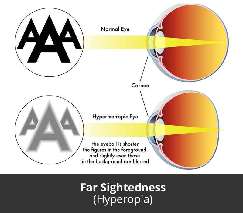 Dr Jimmy Lim JL Eye Specialists Far Sightedness Hyperopia Chart