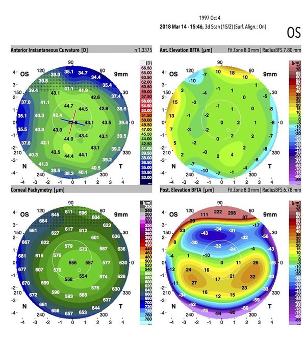 Dr Jimmy Lim JL Eye Specialists Cornea Healthy Cornea Topographical Galilei G6 Scan Results KPI
