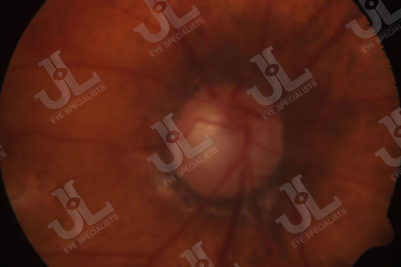 low-or-normal-tension-glaucoma-imaging