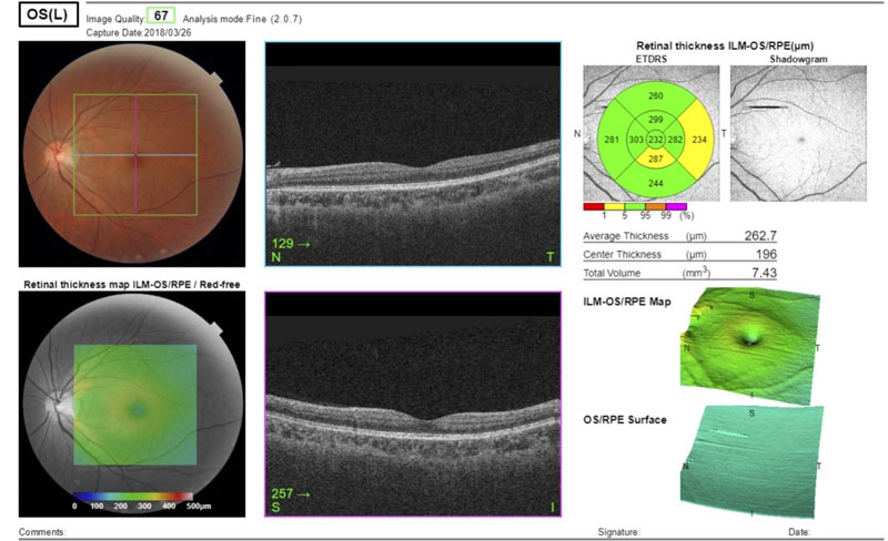 Dr Jimmy Lim JL Eye Specialists Clinic in Singapore OCT Angiography Healthy Macula Left