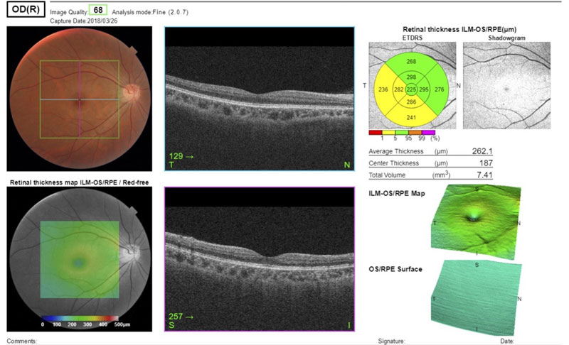 Dr Jimmy Lim JL Eye Specialists Clinic in Singapore OCT Angiography Healthy Macula Right