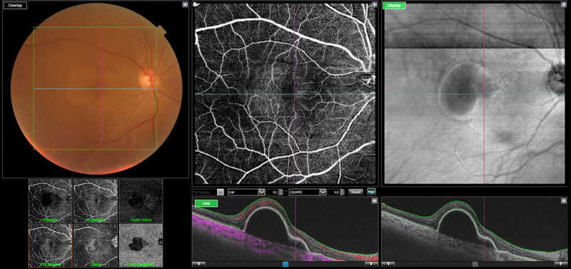 Dr Jimmy Lim JL Eye Specialists Clinic in Singapore OCT Angiography Macular Degeneration