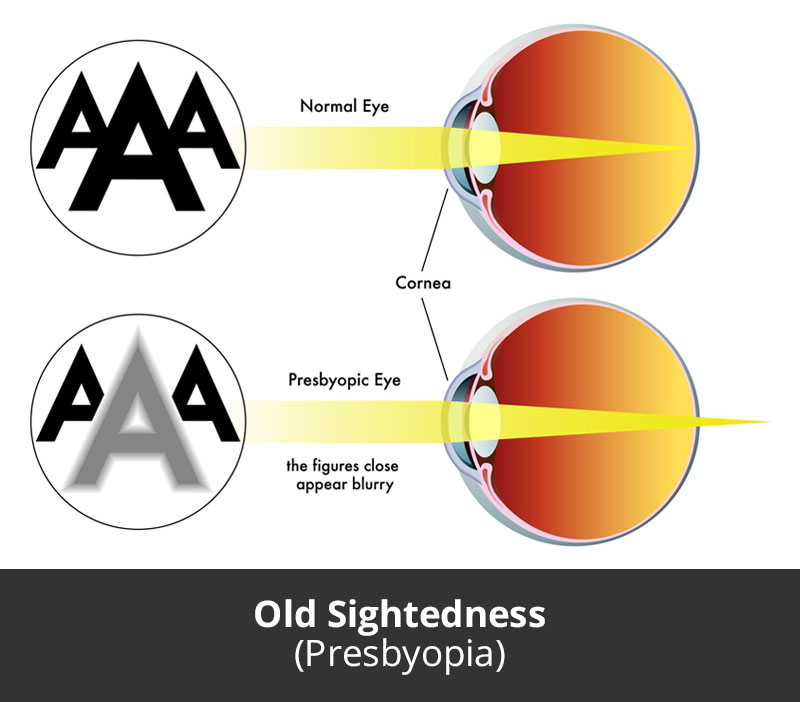 Dr Jimmy Lim JL Eye Specialists Old Sightedness Presbyopia Chart