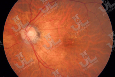 retinal-imaging-macular-degeneration-fundus-imaging-left