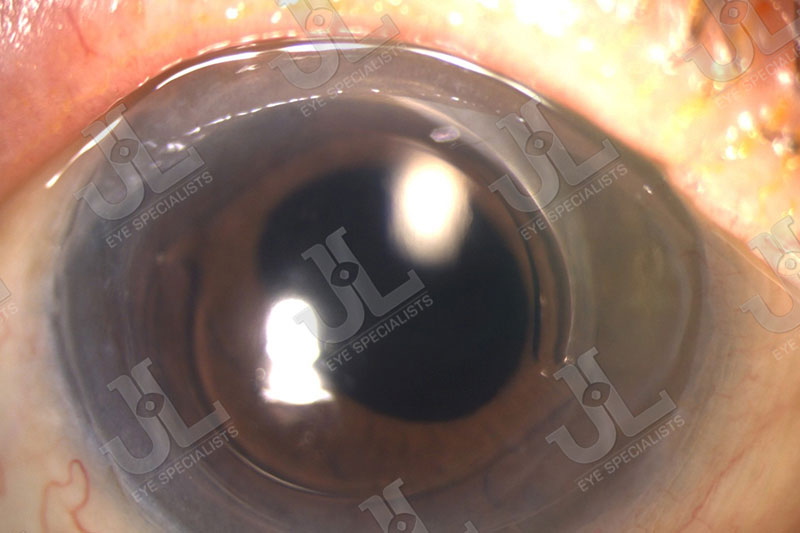 Dr Jimmy Lim JL Eye Specialists Swollen Cornea Imaging Full Eye