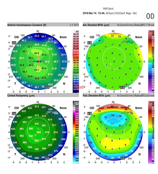 Dr Jimmy Lim JL Eye Specialists Corneal Thickness Topographical Galilei G6 Scan Results KPI
