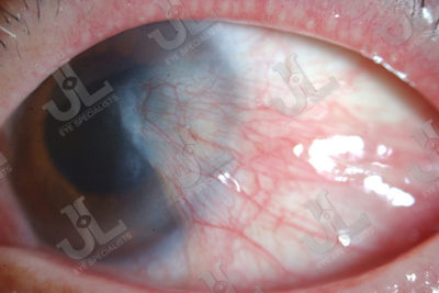 cronea-pterygium-right-eye