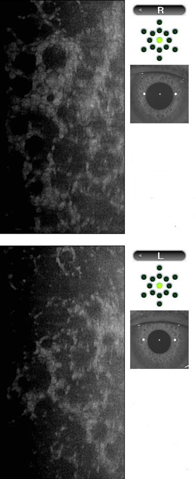 fuchs-endothelial-cell-dystrophy-imaging-constricted