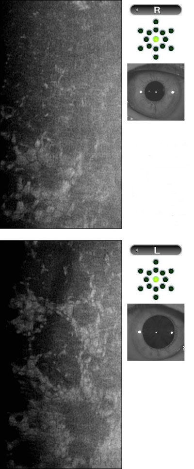 fuchs-endothelial-cell-dystrophy-imaging-dilated