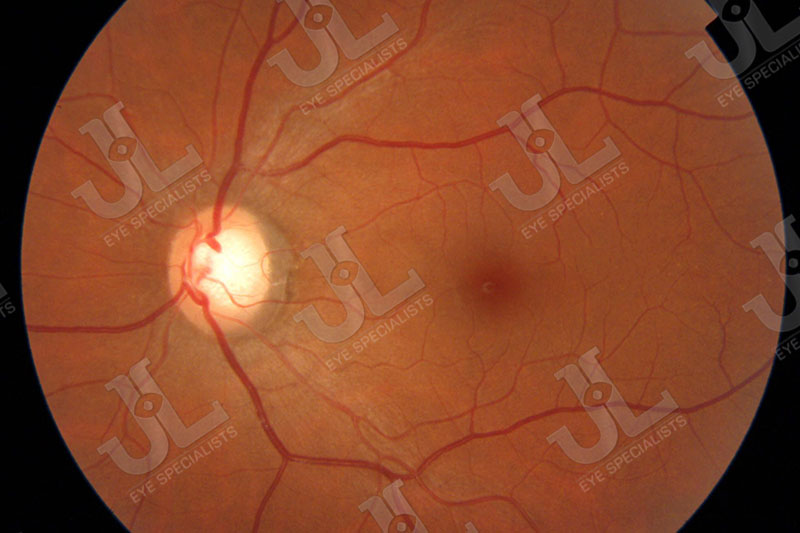Dr Jimmy Lim JL Eye Specialists Clinic in Singapore Open-angle glaucoma