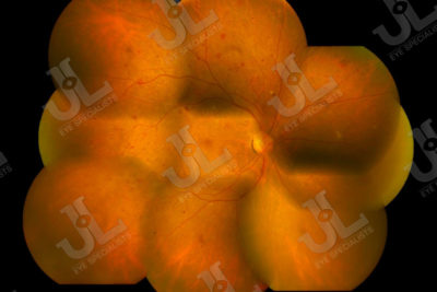 Dr Jimmy Lim JL Eye Specialists Clinic in Singapore Retina Service Retinal Fundus Imaging