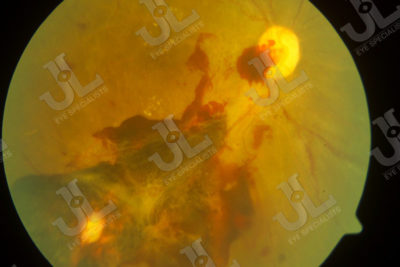 Dr Jimmy Lim JL Eye Specialists Clinic in Singapore Retina Service Retinal Fundus Imaging Red Clumps