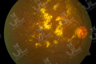 Dr Jimmy Lim JL Eye Specialists Clinic in Singapore Retina Service Retinal Fundus Imaging White