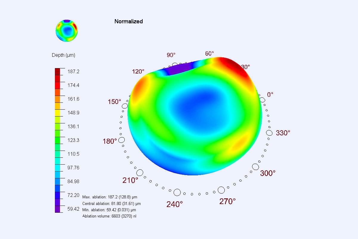 Dr Jimmy Lim JL Eye Specialists SCHWIND CAM module ORK-CAM treatment planning chart normalized