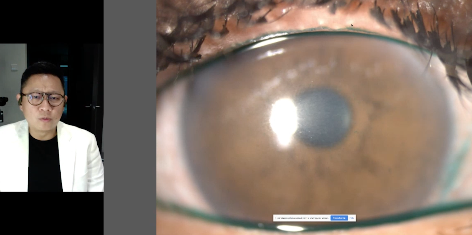 Dry Eye Drops: A deeper look beyond simple symptom relief – Alcon, Webinar, Singapore