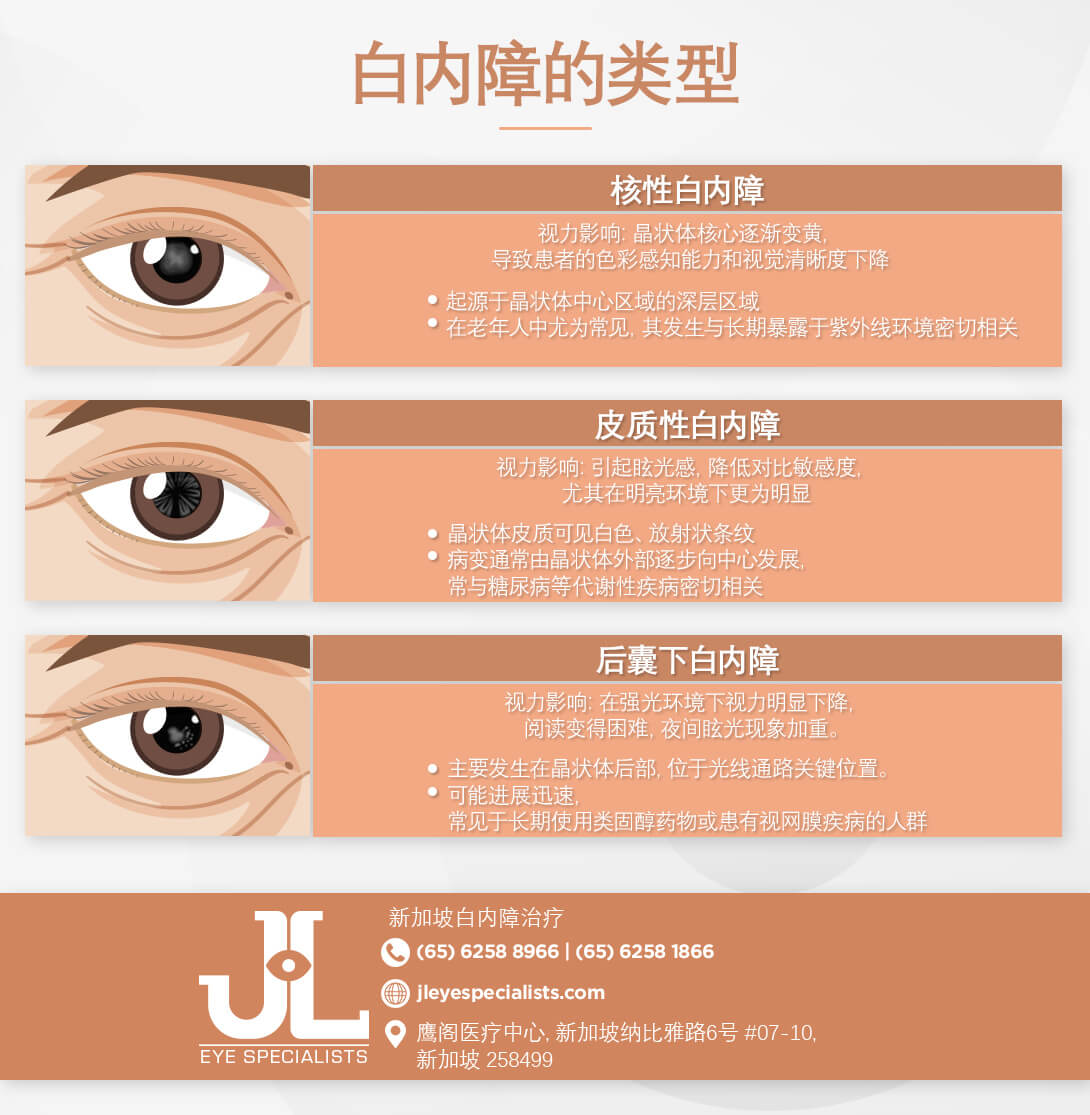 白内障的类型