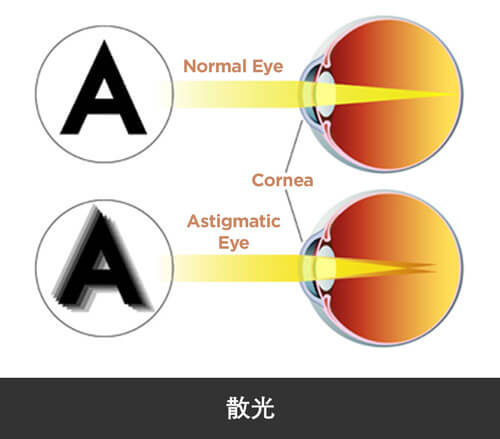 jl-eye-specialists-clinic-singapore-astigmatism