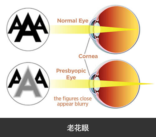 老花眼