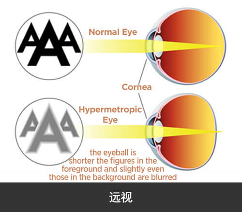 远视